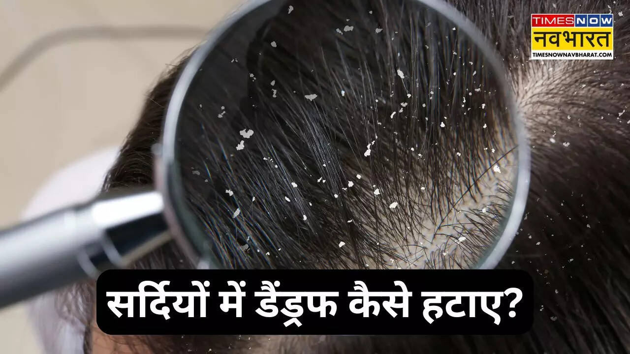 बालों में डैंड्रफ और उसके उपाय