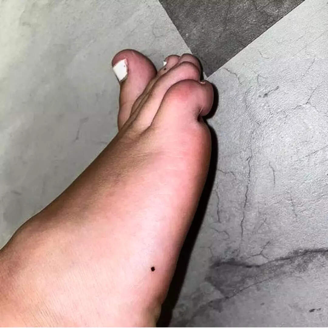 पैर का तिल 