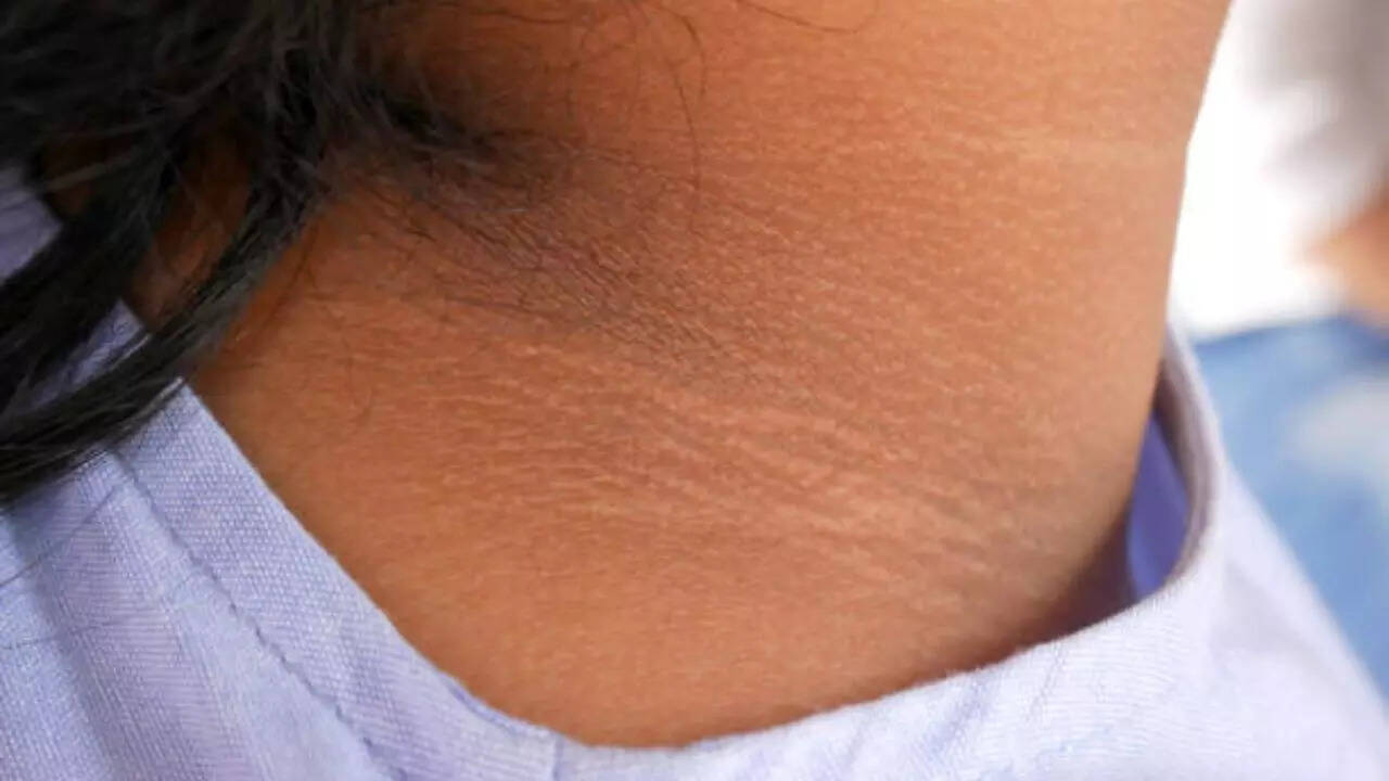 गर्दन का कालापन दूर करने के घरेलू उपाय