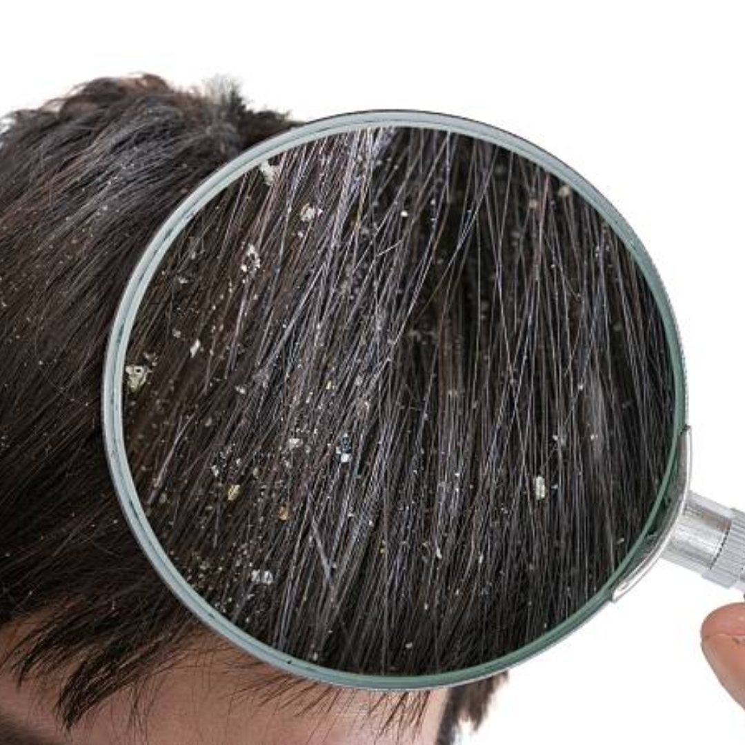 Javed habib remedy to get rid dandruff and lice in hindi | जावेद हबीब ...