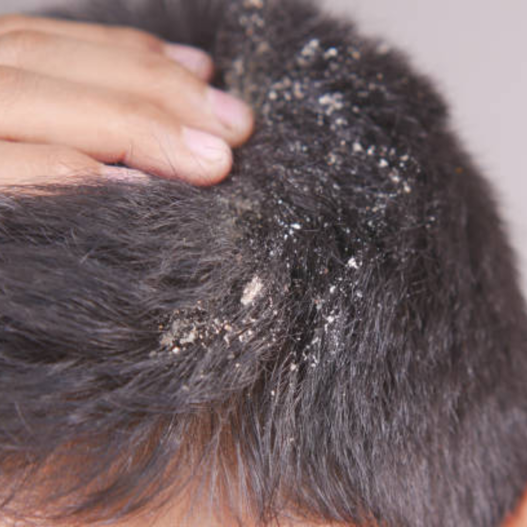 Javed habib remedy to get rid dandruff and lice in hindi | जावेद हबीब ...