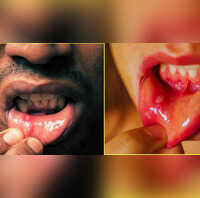दो हफ्ते से ज्यादा बना है मुंह का छाला हो सकता है गंभीर बीमारी का इशारा