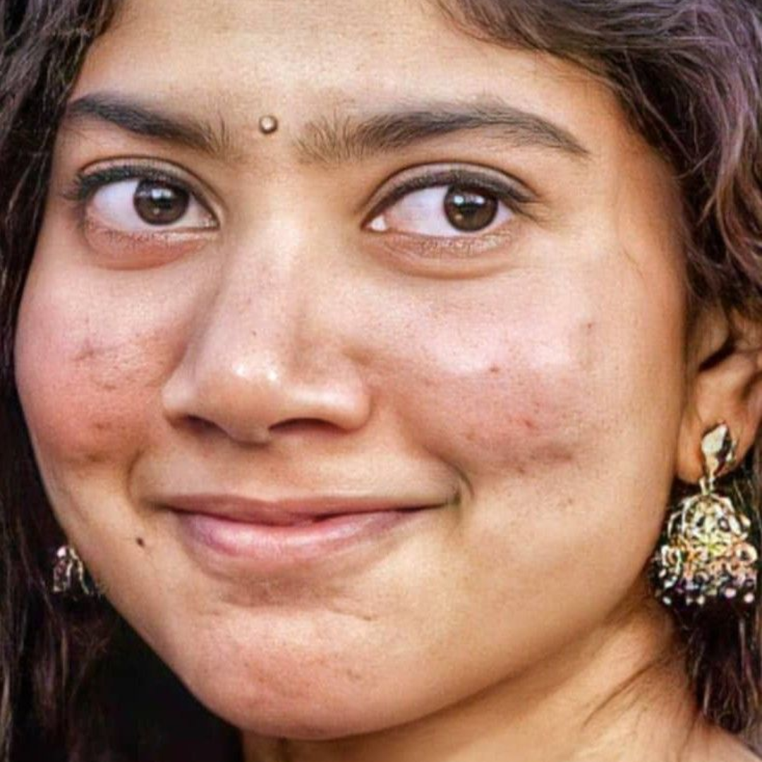 Acne और Rosacea में क्या फर्क है?