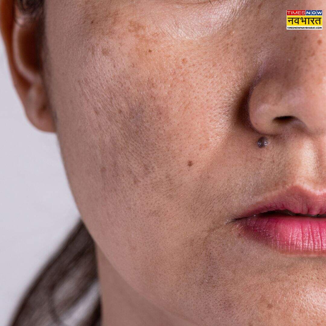 ​धूप और UV Rays​