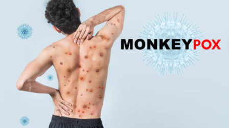 शरीर में दिख रहे ये 5 लक्षण तो 'मंकीपॉक्स' का है खतरा, समय रहते नहीं दिया ध्यान तो हो सकता है जान का खतरा