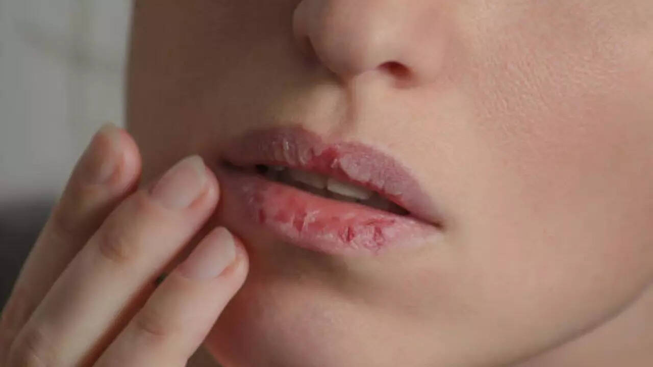How to get rid of dry lip