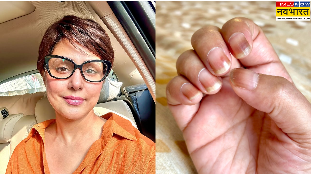 Side Effects of Chemotherapy on Hina Khan