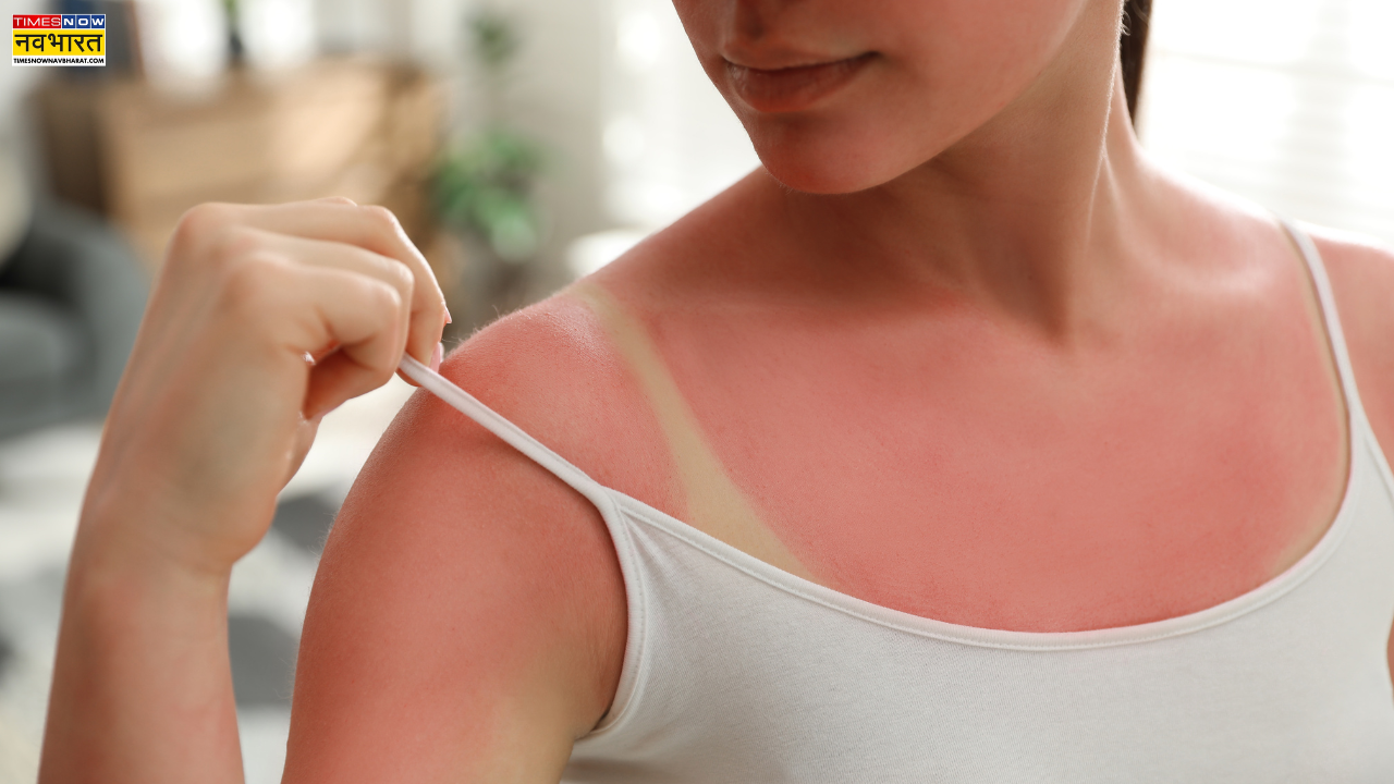 Sunburn remedies, how to cure sunburn, summer skin tips