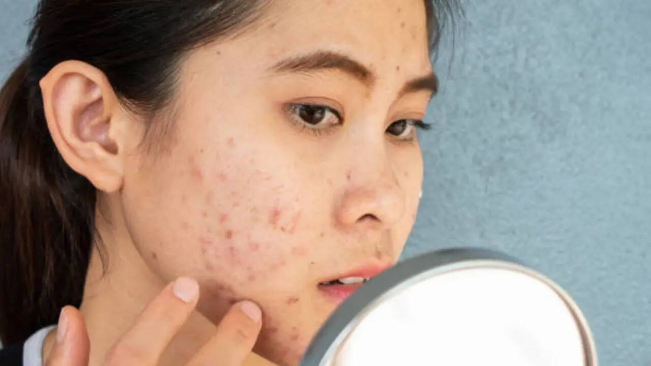 Pimples have filled your face