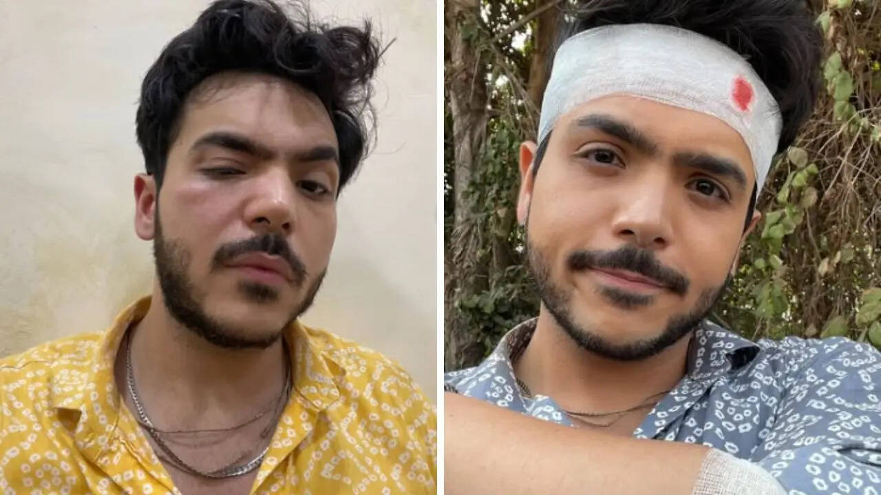राज अनादकट के चेहरे पर लगी चोट