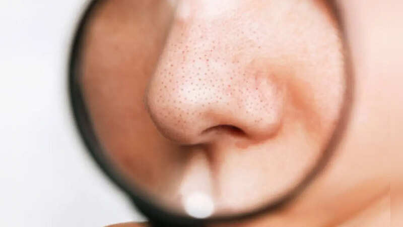 Home remedies to remove blackheads in hindi