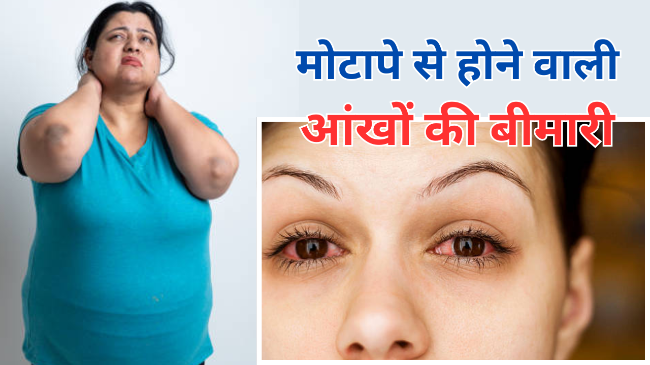 Eye Diseases Caused By Obesity In Hindi