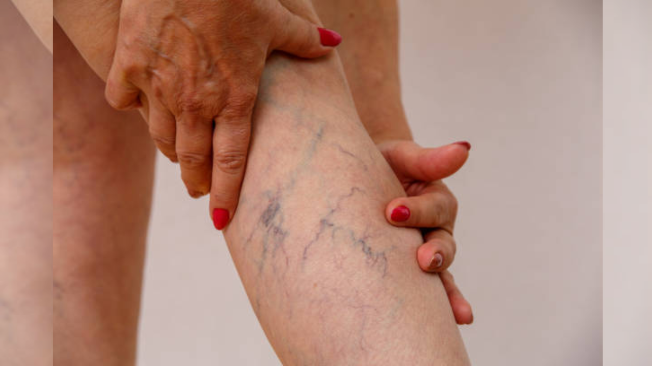 Swelling In Leg Veins Home Remedies In Hindi