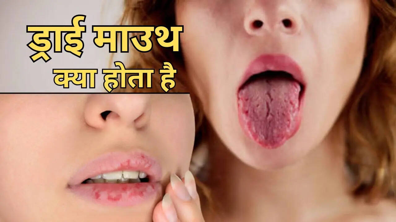 What is Dry Mouth