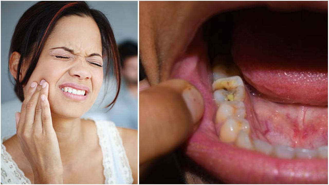 Causes Of Cavity In Teeth Reasons In Hindi