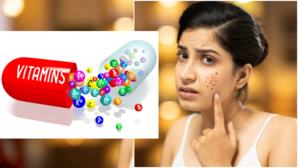 Health Quiz किस विटामिन की कमी से उड़ जाती है चेहरे की रौनक बनती है कील-मुंहासे और धाग-धब्बों की वजह जानिए