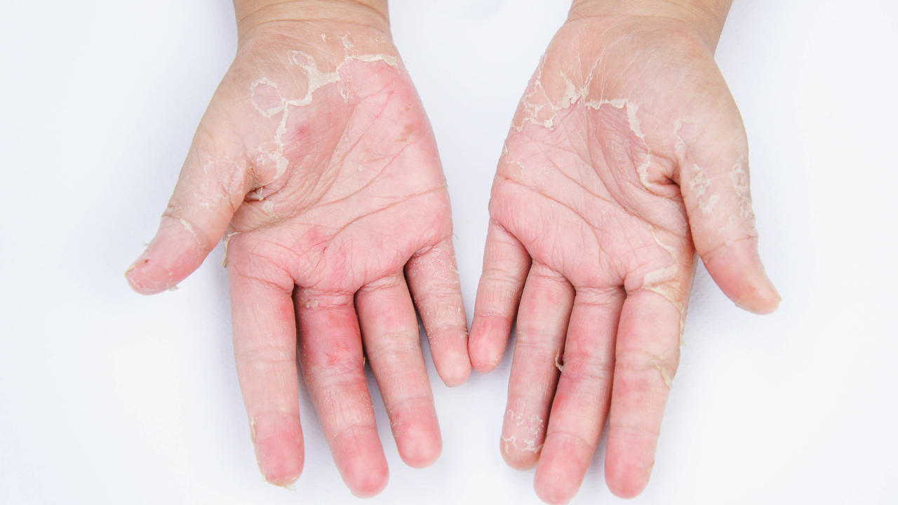 causes of skin peeling