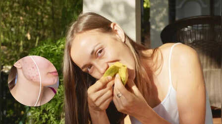 क्या आम खाने से पिंपल्स होते हैं? जान लें Pimple से बचने के लिए किस तरह खाएं Mangoes