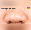 Remedies For Blackheads मेरी मम्मी ने बताया है ब्लैकहेड्स हटाने का ऐसा घरेलू उपाय अब पार्लर जाने की भी नहीं पड़ती है जरूरत