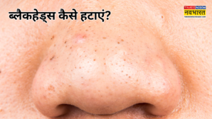 Remedies For Blackheads मेरी मम्मी ने बताया है ब्लैकहेड्स हटाने का ऐसा घरेलू उपाय अब पार्लर जाने की भी नहीं पड़ती है जरूरत