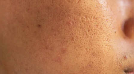 चेहरे के रोम छिद्र बन न जाए पिंपल का कारण, Open Pores को छोटा करने के लिए अपनाएं ये टिप्स