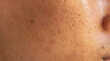 चेहरे के रोम छिद्र बन न जाए पिंपल का कारण Open Pores को छोटा करने के लिए अपनाएं ये टिप्स