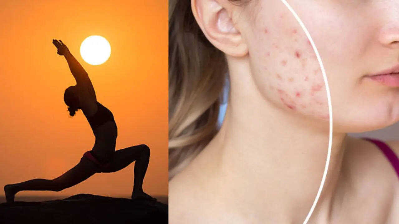 पिंपल से छुटकारा दिलाए योग (Image: istock)