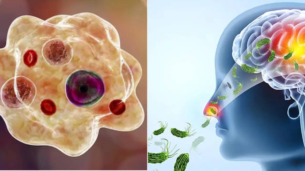 Amoebic meningoencephalitis (image: instagram)