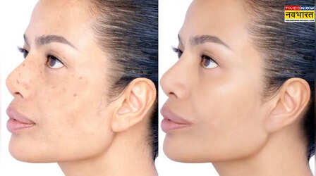 Skin Care: चेहरे की झाइयों से हैं परेशान ? ये घरेलू उपचार हैं बेहद आसान