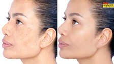 Skin Care: चेहरे की झाइयों से हैं परेशान ? ये घरेलू उपचार हैं बेहद आसान