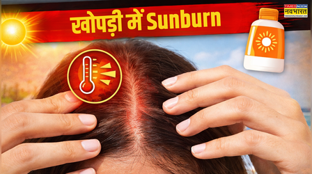 चेहरा बचाया, लेकिन सिर जल गया.. चिलचिलाती गर्मी में रहता है स्कैल्प सनबर्न का खतरा, जानें कैसे करें बचाव