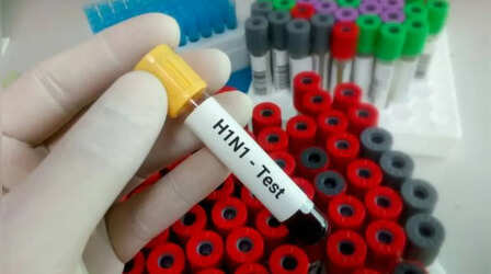 Indore News: इंदौर में H1N1 का इलाज कराने के बाद 62 साल की महिला की मौत, जांच के आदेश