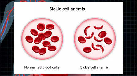 Sickle Cell Anemia: मोदी सरकार ने रखा सिकल सेल एनीमिया को 2047 तक मिटाने का लक्ष्य, जानें किनको होती है ये बीमारी, लक्षण और इलाज